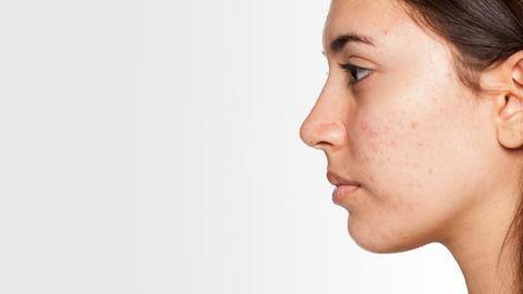 What is skin purging? Here's all you need to know What is skin purging? Here's all you need to know