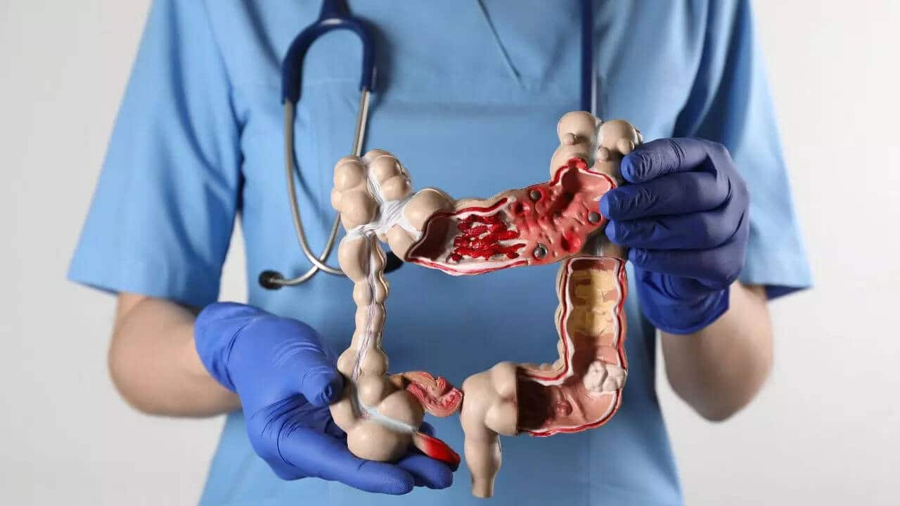 Colorectal cancer cases rising among Indian adults under 50: Report