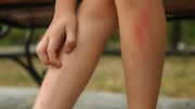 Soothe mild shin irritation with these home remedies