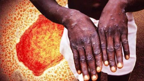 Monkeypox poses moderate risk to global public health: WHO Monkeypox poses moderate risk to global public health: WHO