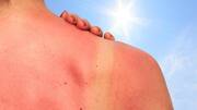 An effective remedy for sunburn is lying in your kitchen!