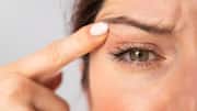 Irritated eyelids? Try these natural remedies