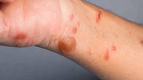 NewsBytesExplainer: What is tomato flu, the new virus in Kerala NewsBytesExplainer: What is tomato flu, the new virus in Kerala