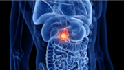 Early detection of gallbladder cancer might soon become easier