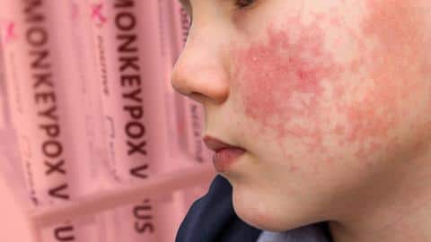 Monkeypox: Maharashtra, Tamil Nadu, Rajasthan prepare to fight against virus Monkeypox: Maharashtra, Tamil Nadu, Rajasthan prepare to fight against virus