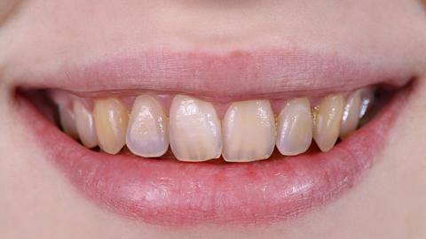Four home remedies to remove accumulated tartar from teeth Four home remedies to remove accumulated tartar from teeth