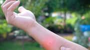 Fix insect bites at home with these remedies