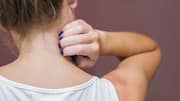 These kitchen ingredients can help fix nape itching 
