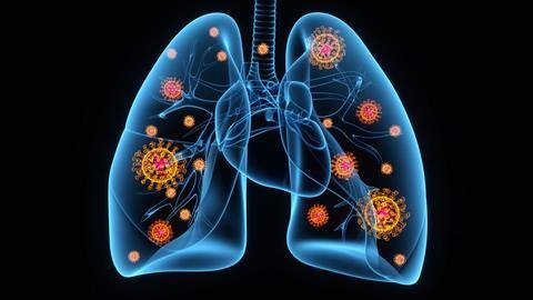 #HealthBytes: Know what makes COVID-19 pneumonia different and deadly #HealthBytes: Know what makes COVID-19 pneumonia different and deadly