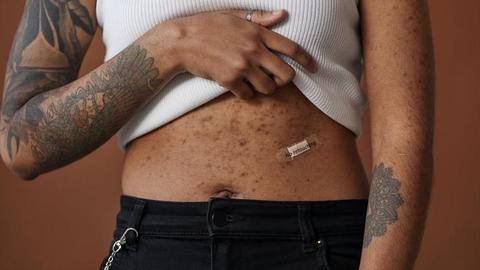 What causes body acne and how to treat it What causes body acne and how to treat it