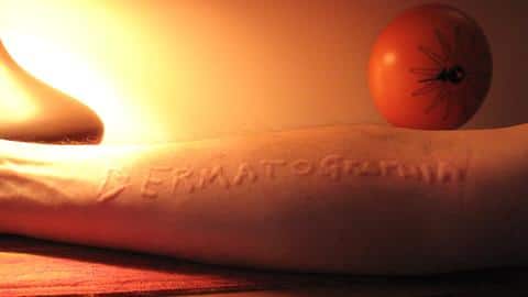 What is dermatographia and how to prevent it What is dermatographia and how to prevent it