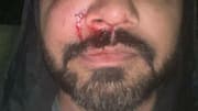 Dublin-based Indian-origin man beaten, cheekbone fractured in unprovoked 'racist' attack 