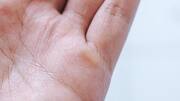 Get rid of calluses using these effective home remedies