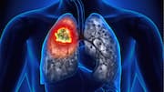 Air pollution linked to lung cancer in non-smokers