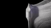 3D-printed heart valve that grows with patient shows promise