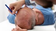 Hair transplant: Types, risks, side effects, and recovery