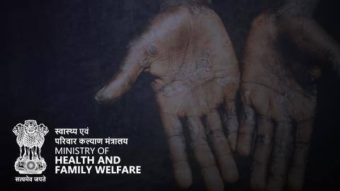 Health Ministry to release guidelines on monkeypox soon Health Ministry to release guidelines on monkeypox soon
