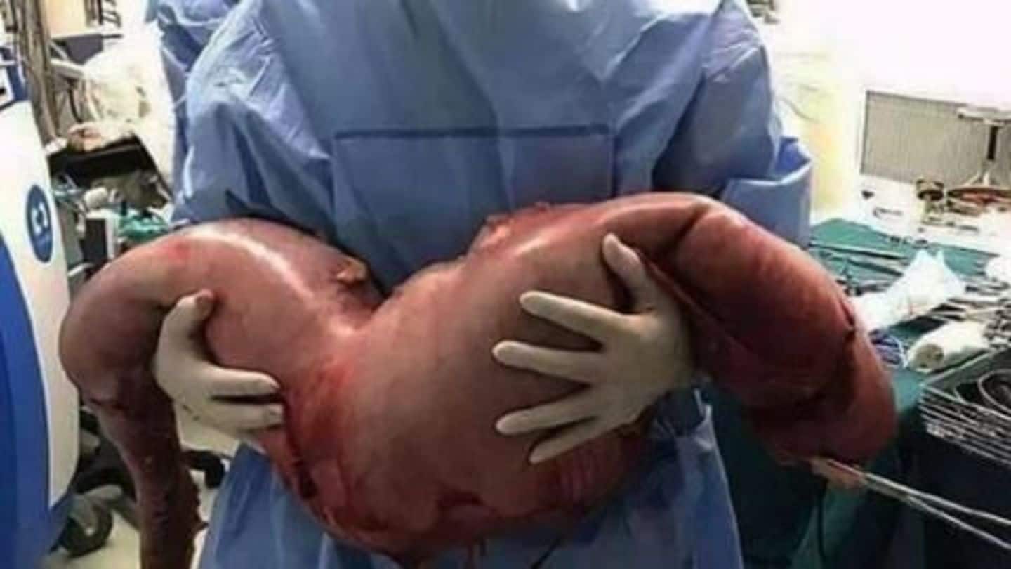22-year-old gets 13kg of poop surgically removed; Shit gets serious!