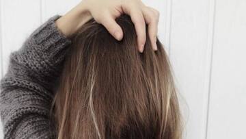 #HealthBytes: Dandruff- Causes and treatment