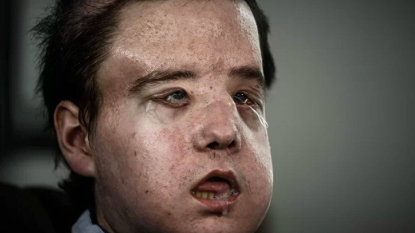 Meet the first person to undergo two face transplants