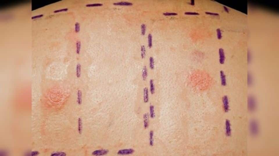 US start-up making skin patches for delivering medicines into body