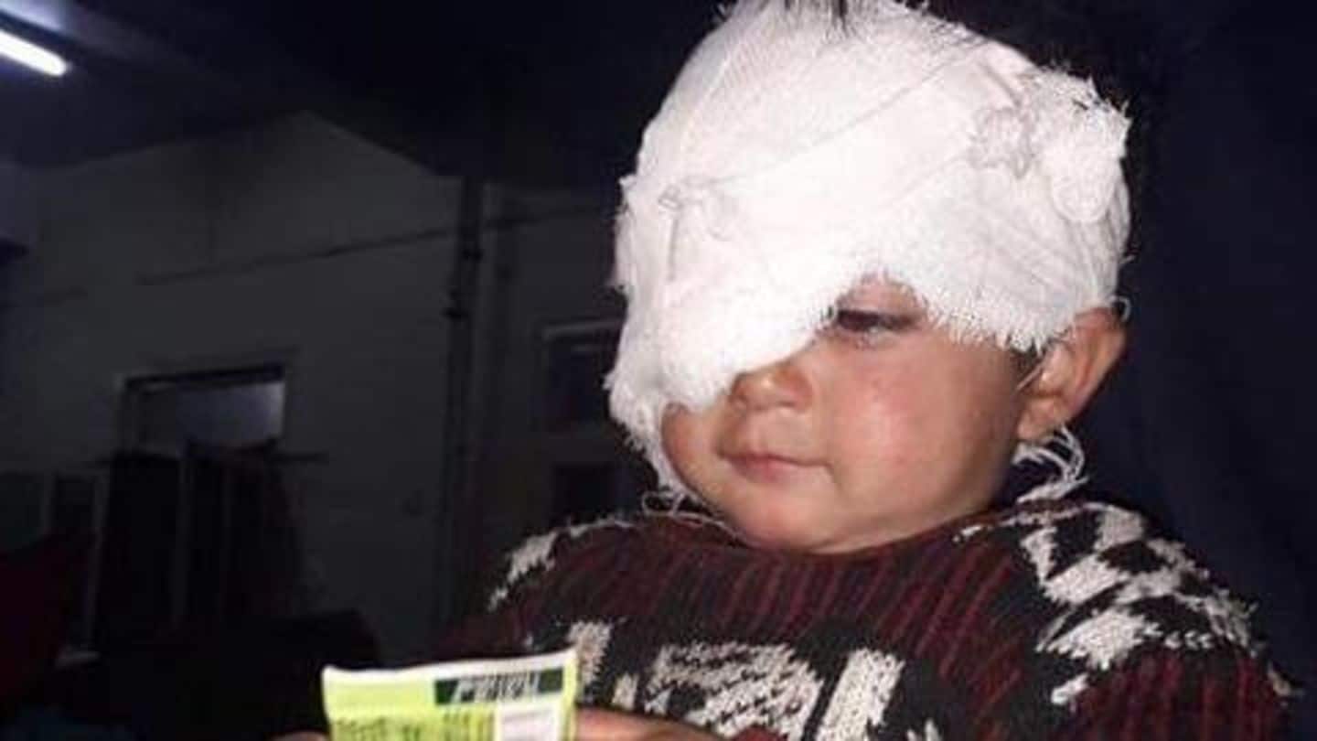 Kashmir: After pellet injury, 20-month-old baby could lose eyesight