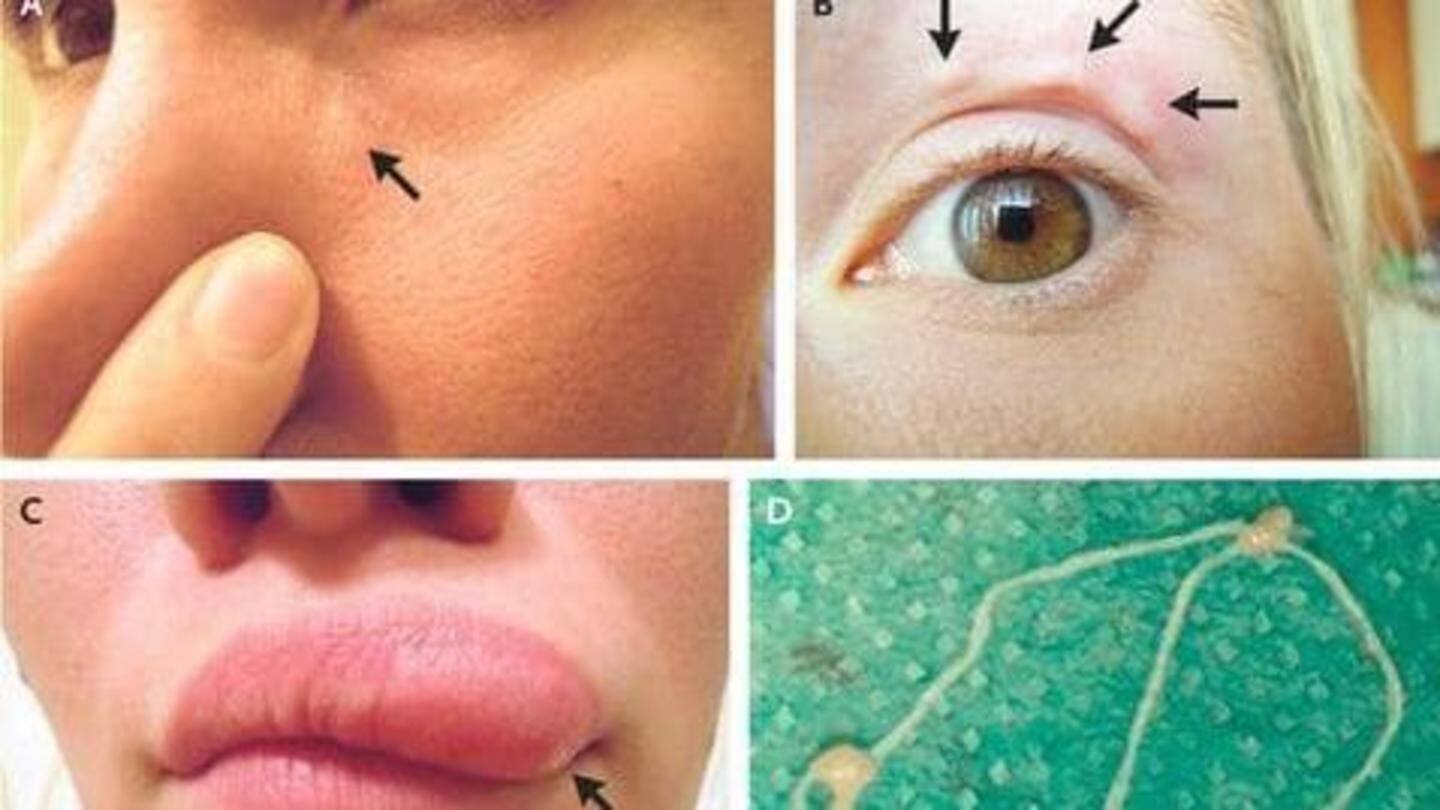 Woman has 'moving blemishes', turns out they are parasitic worms