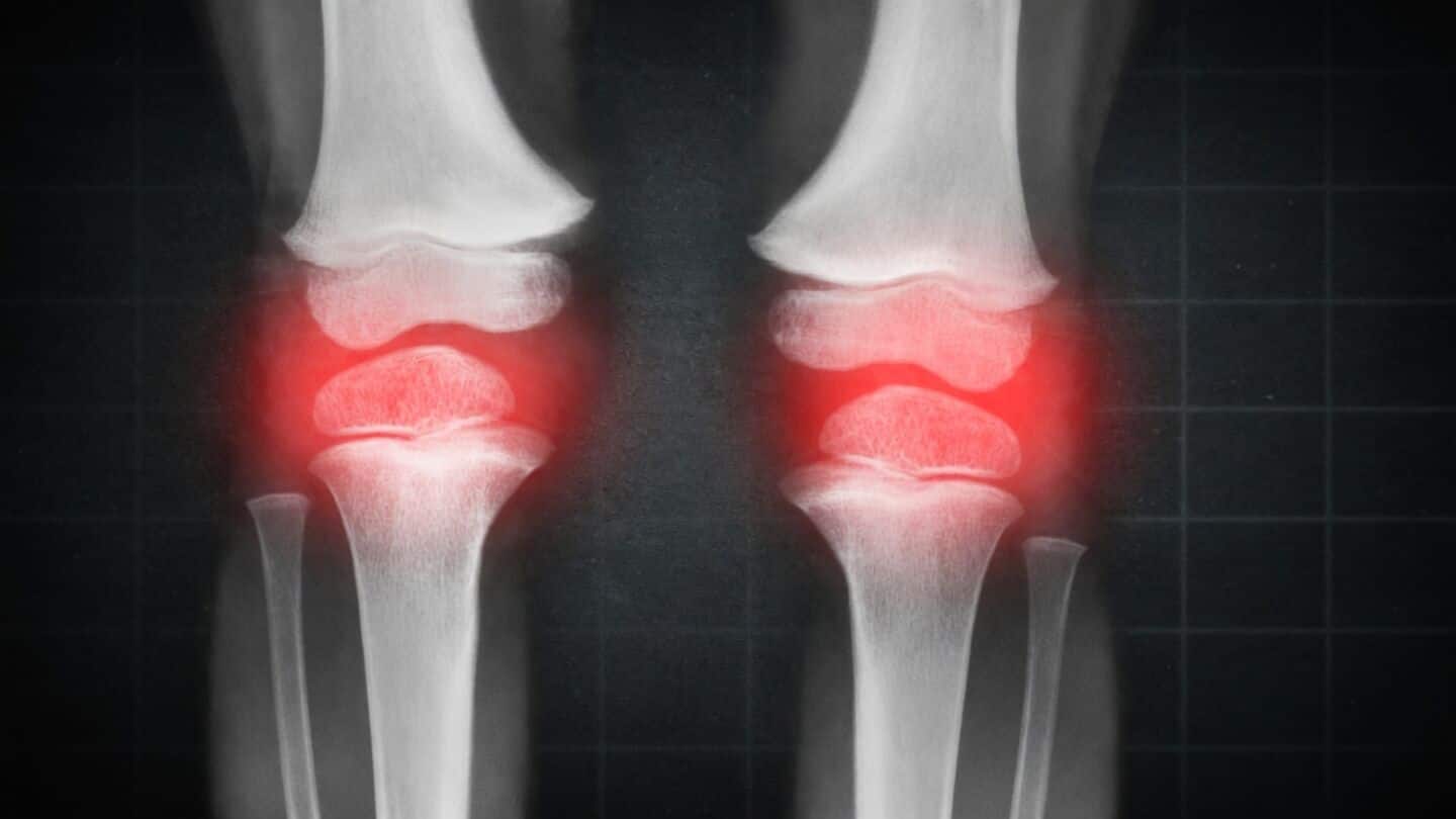Stanford scientists block 15-PGDH to regrow cartilage using chondrocytes