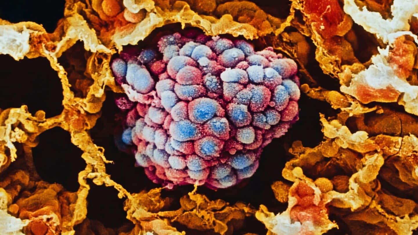 UAE researchers find mebendazole may boost gefitinib in lung cancer