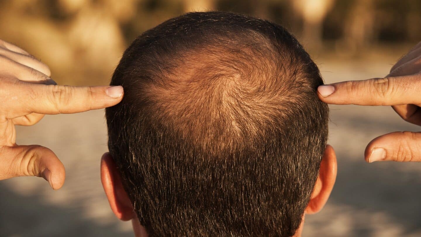 NYU study: Ozempic, Wegovy may raise male pattern hair loss