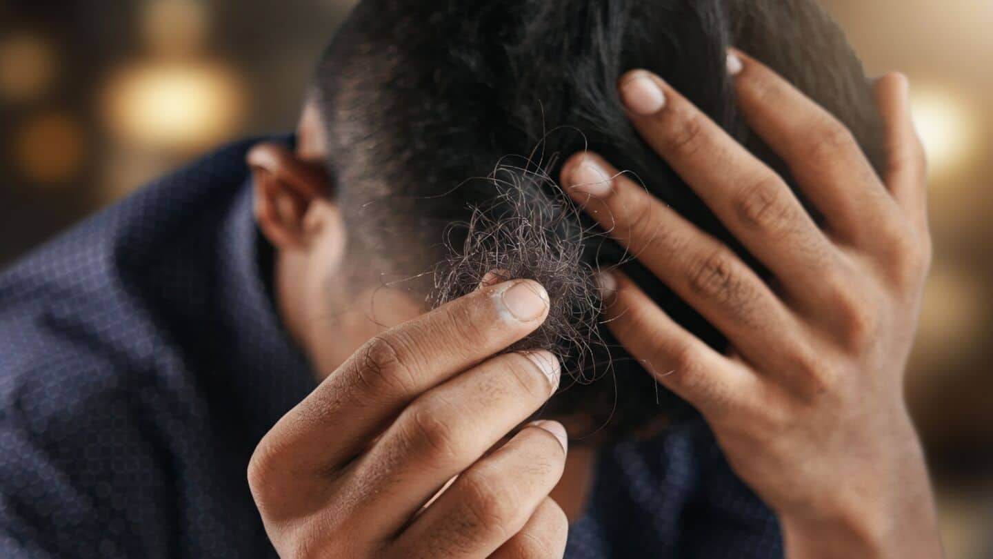 Upadacitinib shows strong hair regrowth in alopecia areata trials