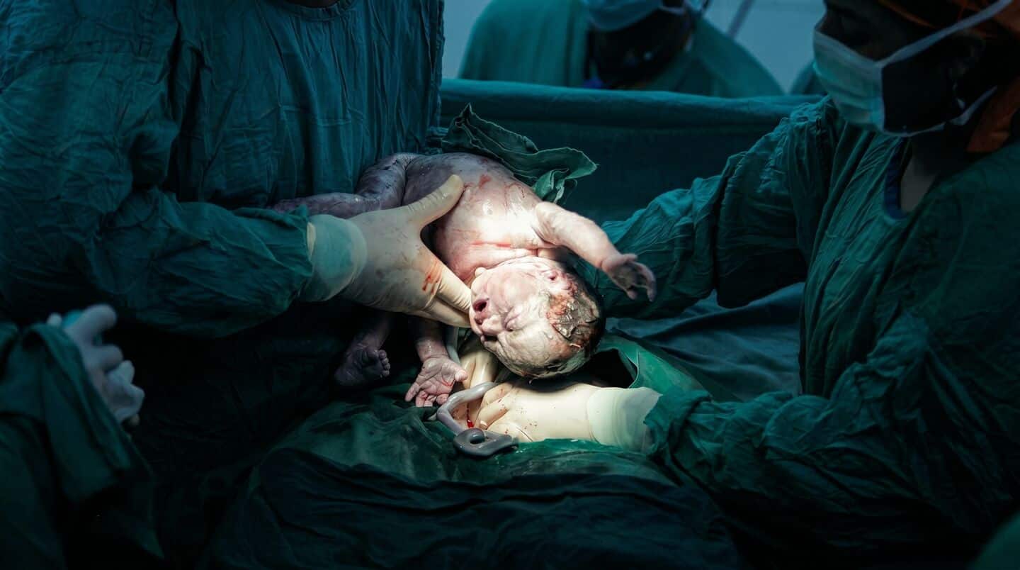 Telangana records 62.2% C-section rate, surpassing national average of 27.2%