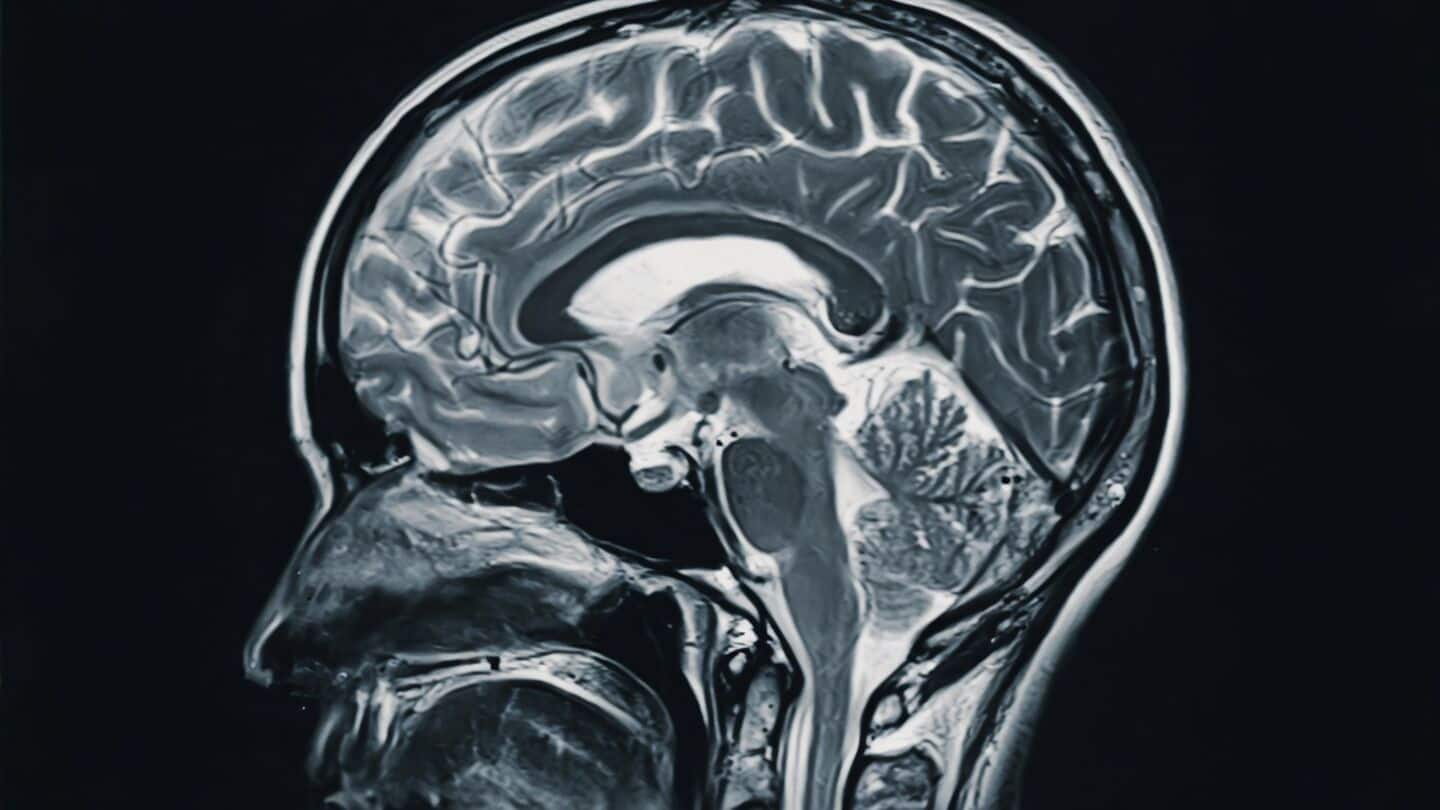 JAMA autopsy explains why aducanumab did not work as hoped