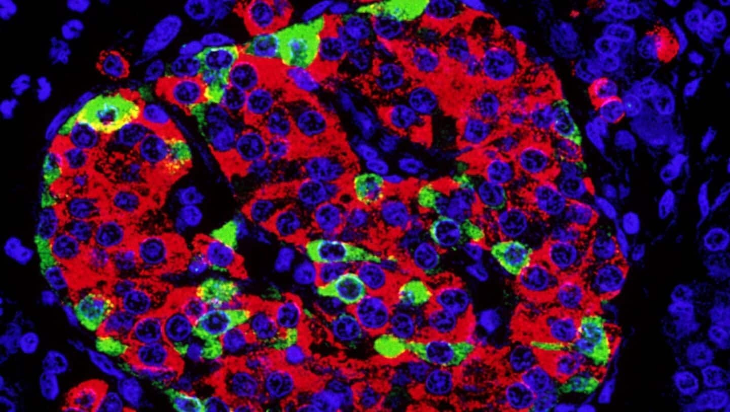 Stem cells free many with type 1 diabetes from insulin