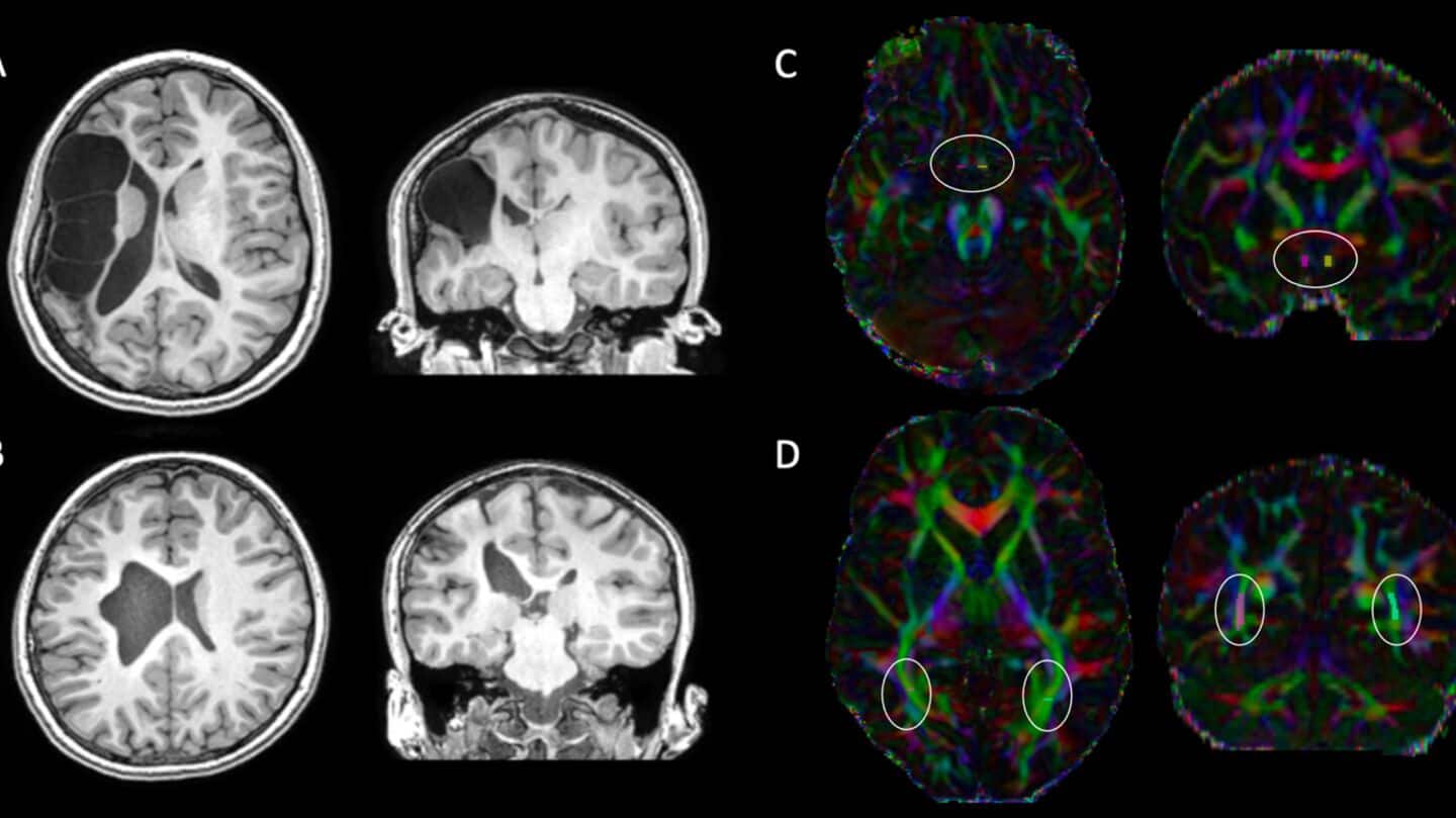 Human brain goes through 5 life stages, says new study