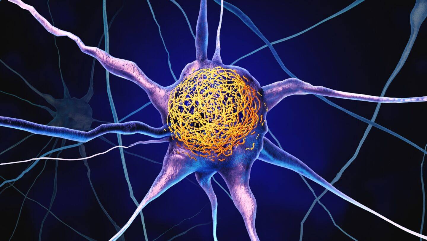 Study links higher vitamin D in 30s to less tau