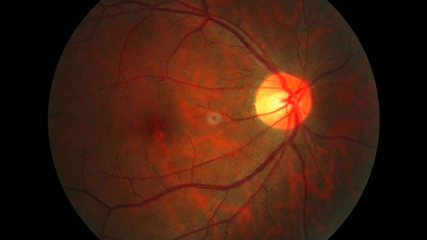 Life Biosciences begins 1st human antiaging gene trial for glaucoma