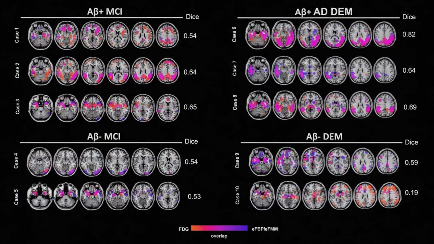 Finland study finds Alzheimer's before 65 shows different warning signs