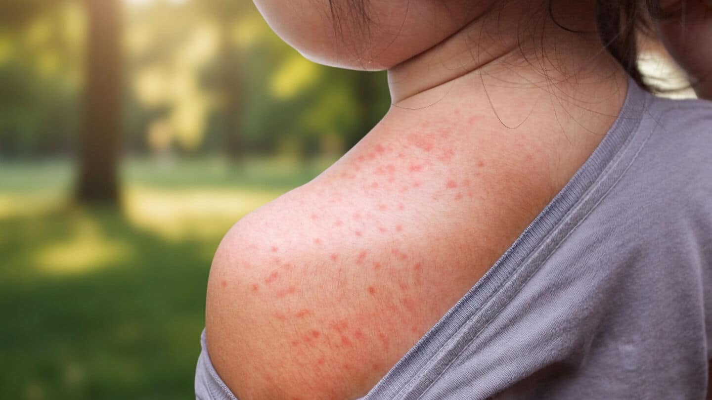 New York state declares disaster emergency after rural measles outbreak