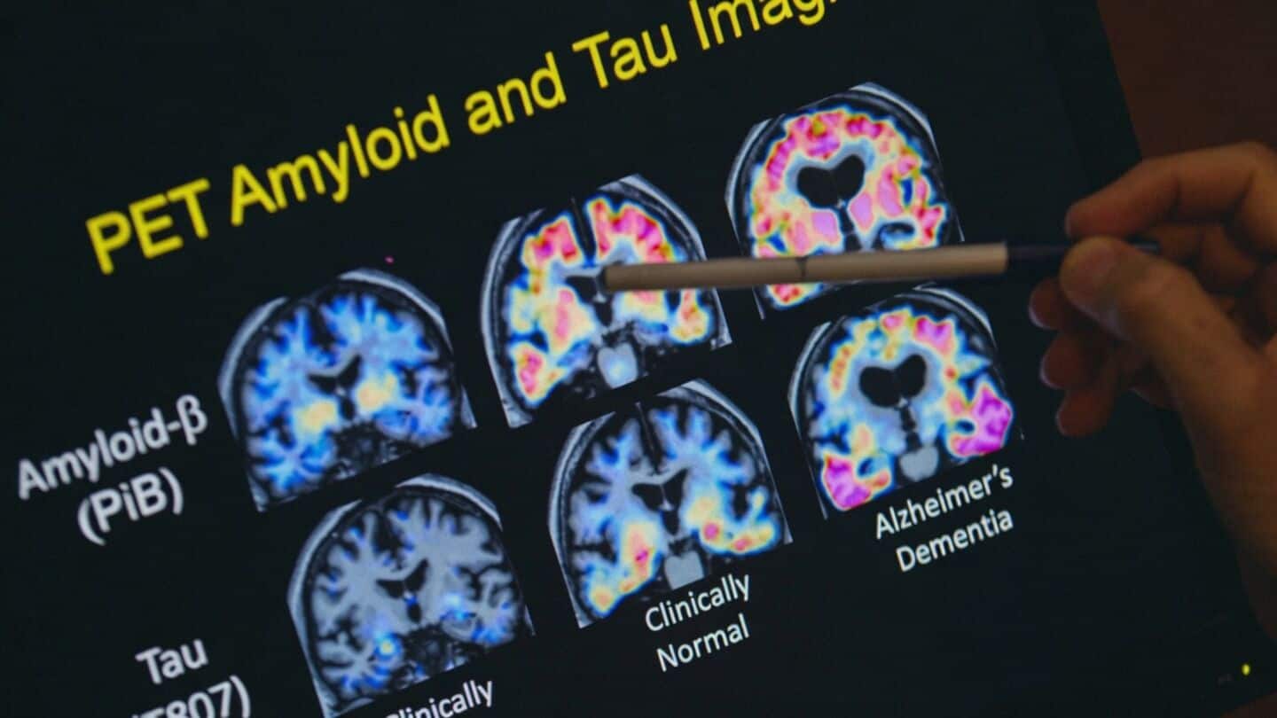 Scientists map DNA folding changes in Alzheimer's brain cells