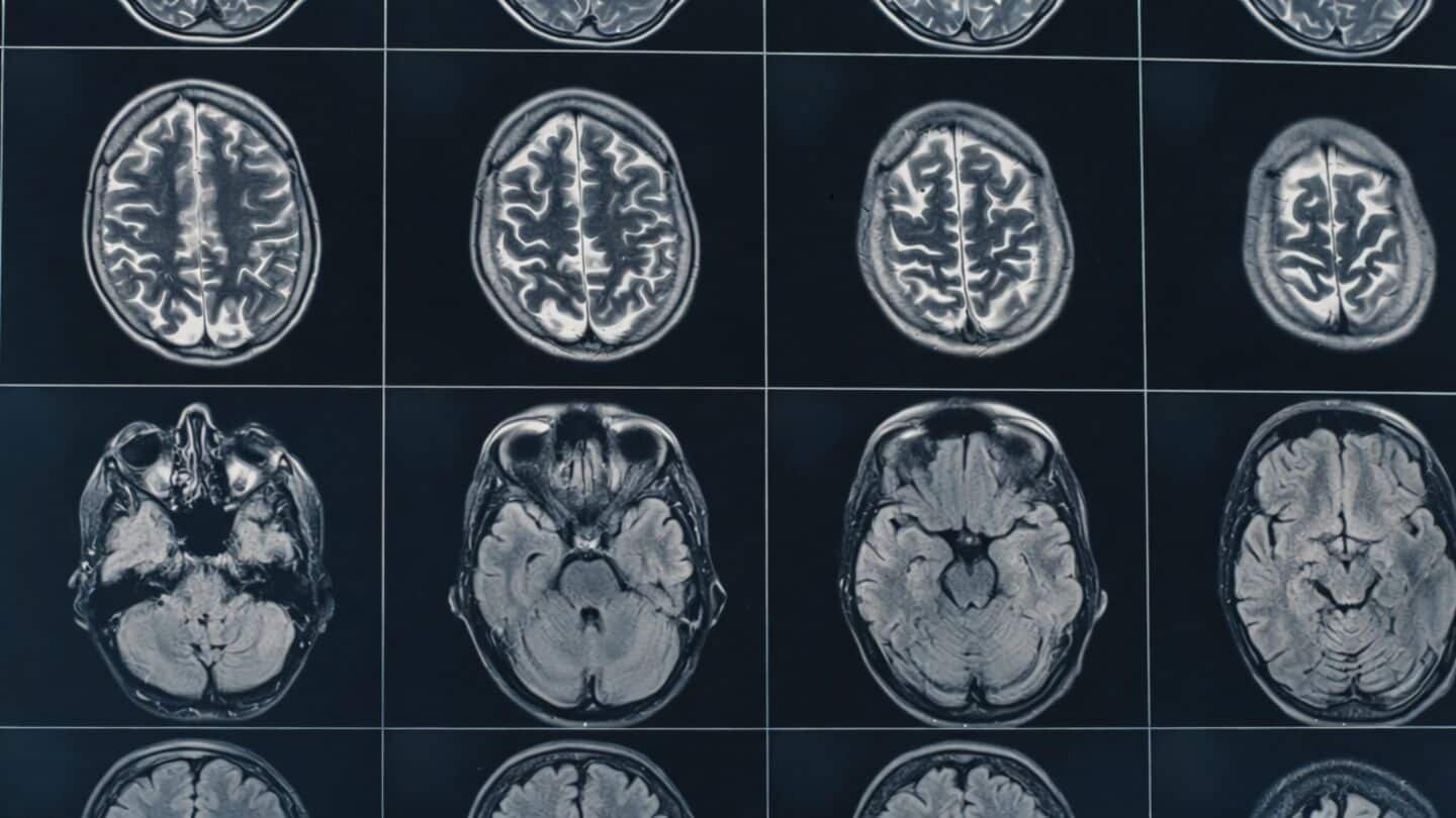 Study suggests immune cells outside brain may drive Alzheimer's damage