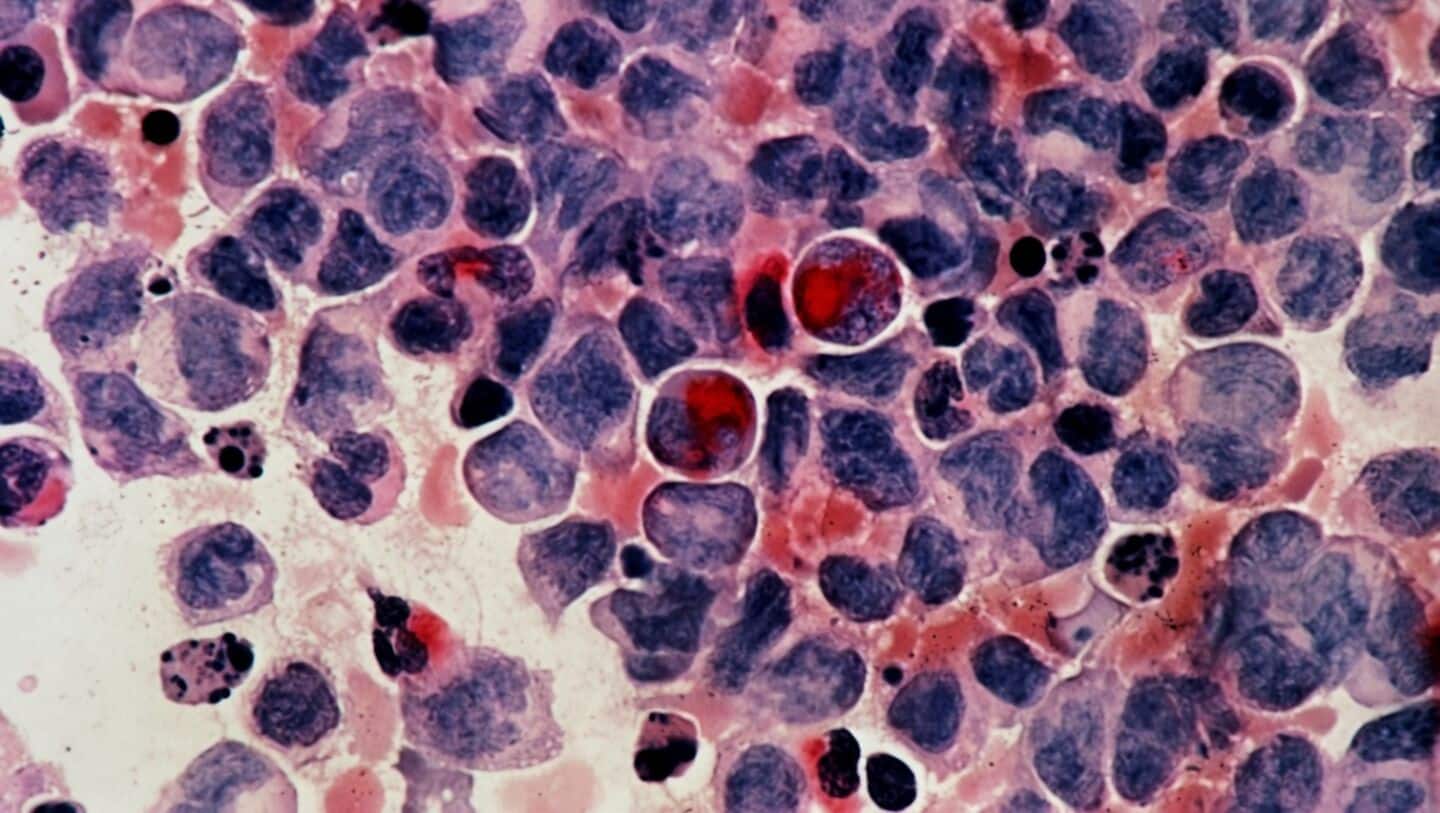 UK Biobank finds 14 blood proteins predict lung cancer risk