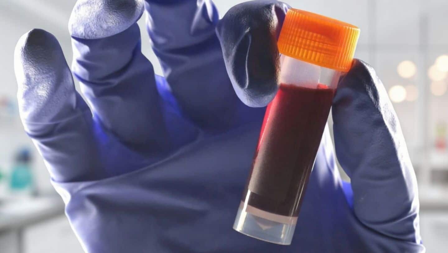 Researchers link blood type B with type 2 diabetes risk