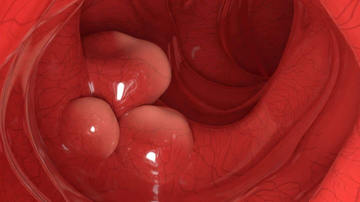 Columbia scientists engineer probiotics to target colorectal tumors in mice