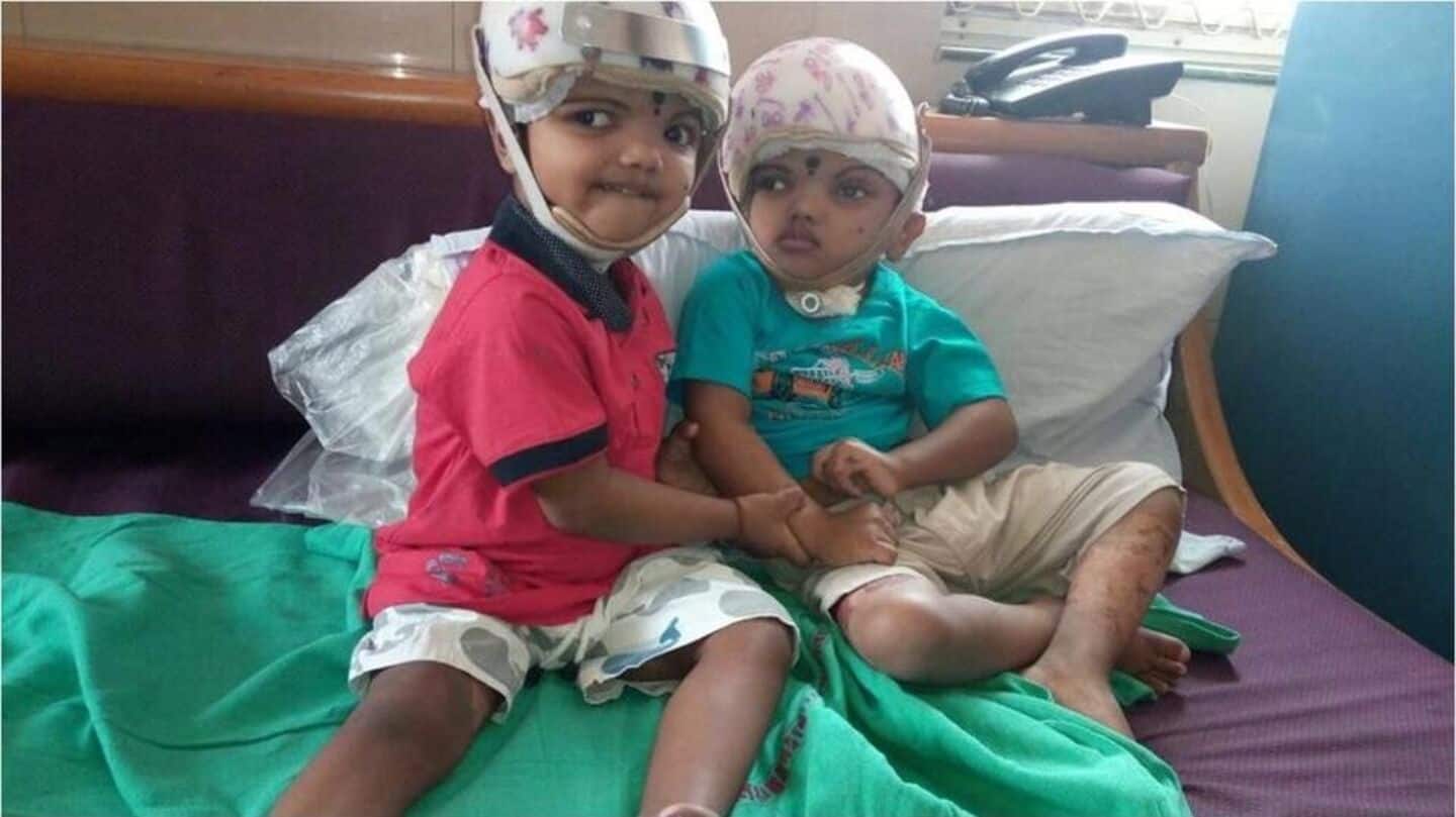 Indore baby born with 2 heads, 1 body