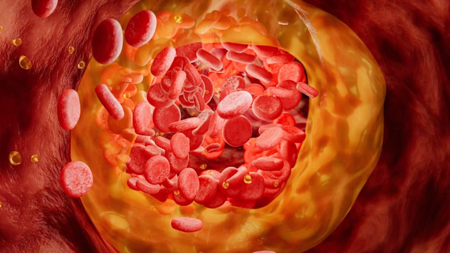 Single dose CRISPR CTX310 reduces LDL over 50% in people