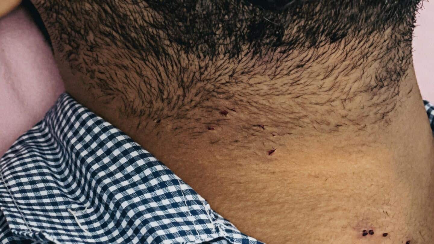 Hospitals confirm 10 pellet gun injuries near Parliament July 20