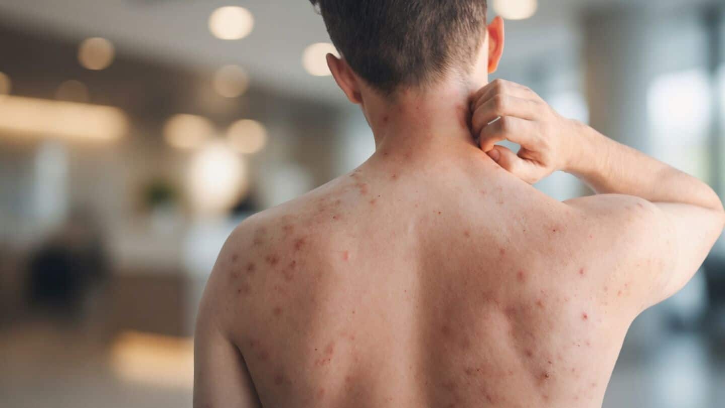 WHO: India logged over 26,627 measles cases 2nd-highest worldwide