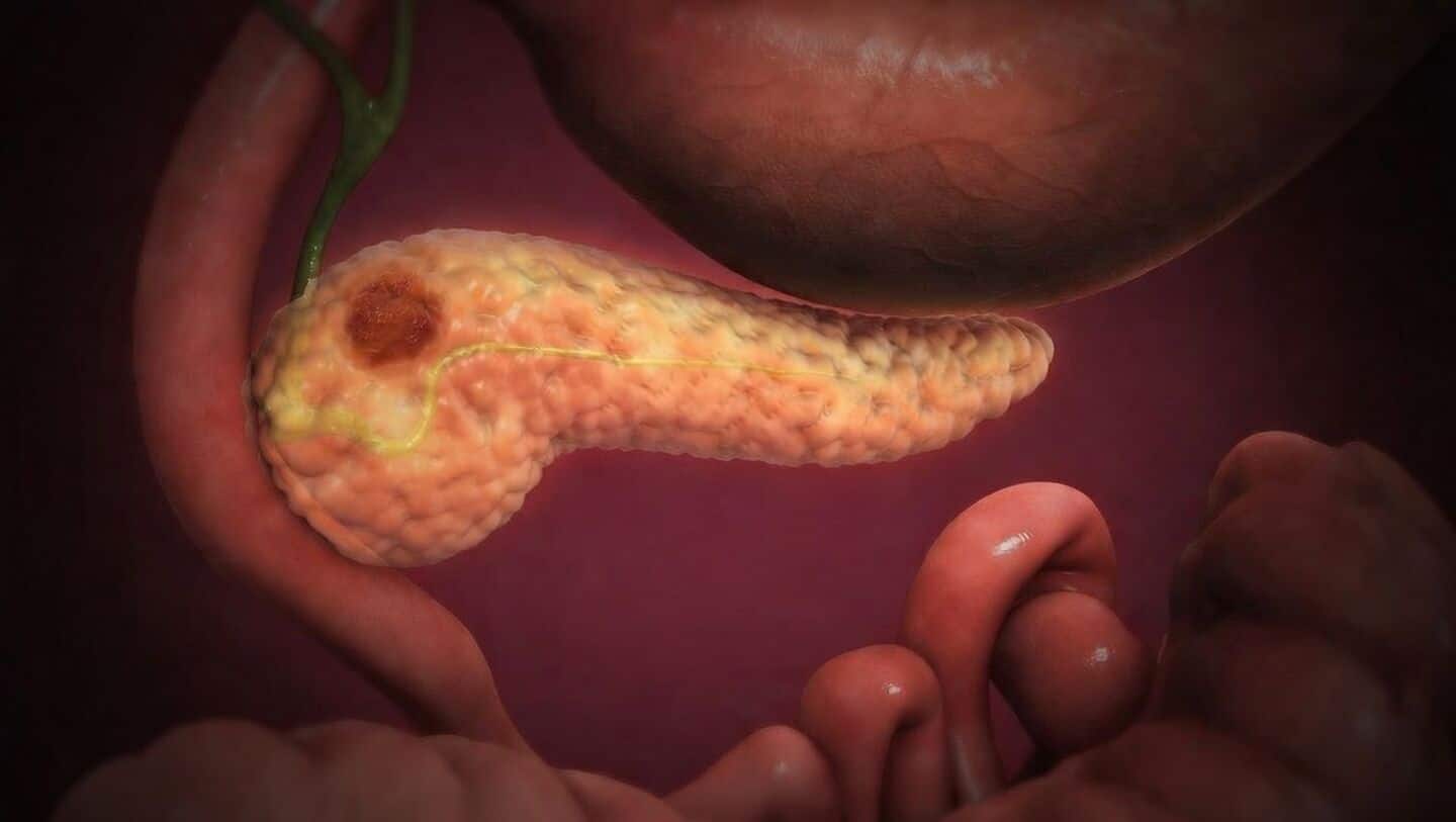 Daraxonrasib shrinks pancreatic tumors and targets multiple RAS proteins