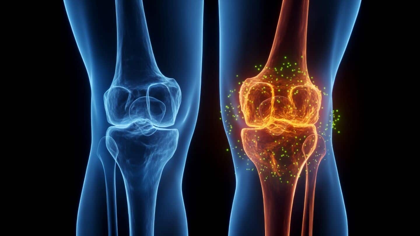 Yale study suggests lacosamide eases osteoarthritis pain and repairs cartilage
